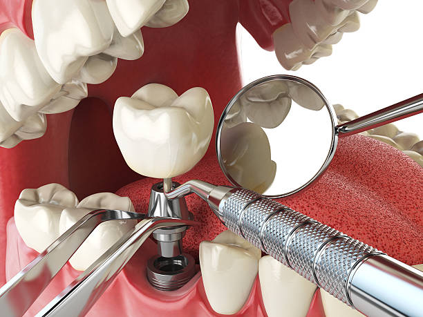 Best Broken Tooth Emergency  in Ke Arthur, LA